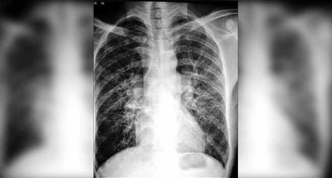 Ispa Serang Ratusan Pekerja Sawit Di Babel